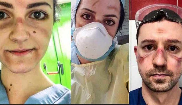Héroes sin capa, así luce el rostro de médicos que luchan día a día vs el coronavirus (fotos)