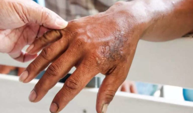 ¿Cómo saber si tienes lepra y cuales son los síntomas?