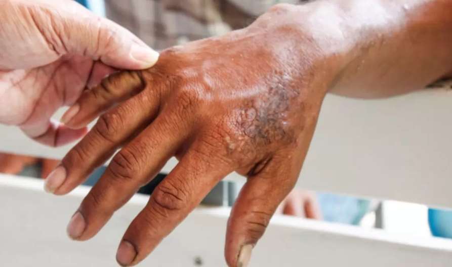 ¿Cómo saber si tienes lepra y cuales son los sintomas?